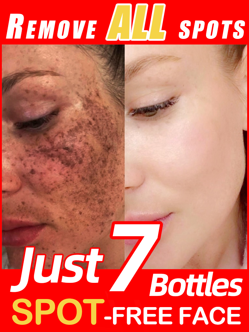 Ultra Luxury Skincare - Ilumina las pecas Melasma, las manchas